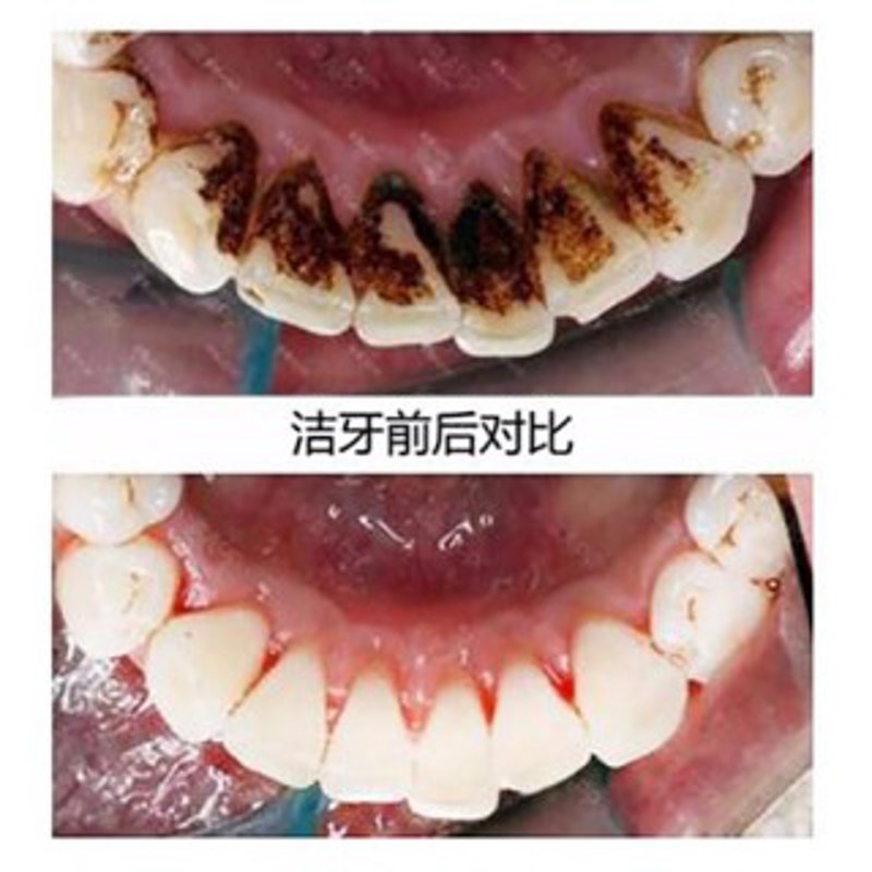 抚州洗牙的必备知识